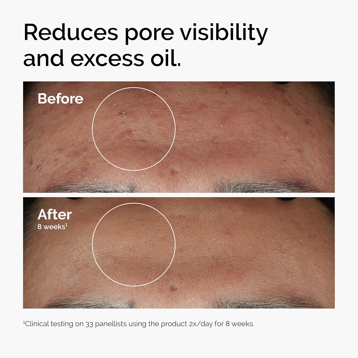 The Ordinary Niacinamide 10% and Zinc 1% Smoothing Serum for Blemish-Prone Skin